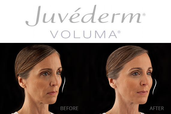 Juvederm VOLUMA XC<