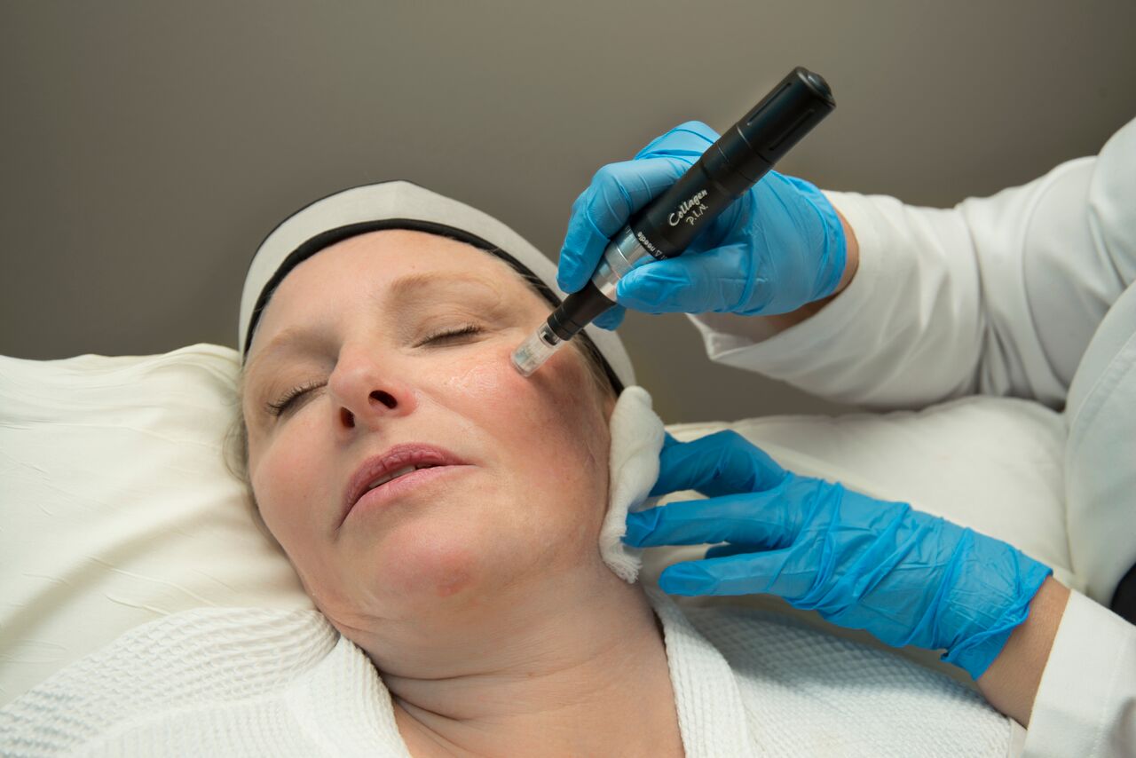 Microneedling with Collagen P.I.N.