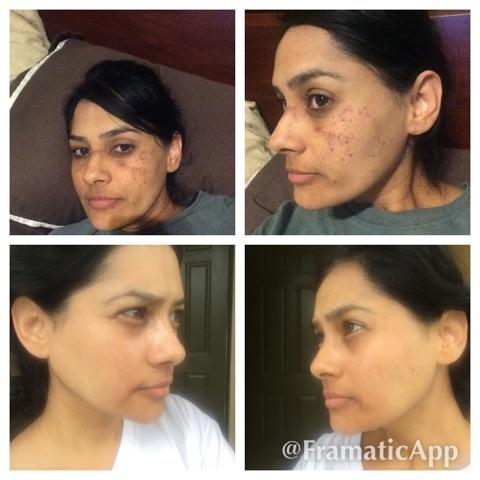 Intense Pulse Light (IPL) treatment at The Woodruff Institute
