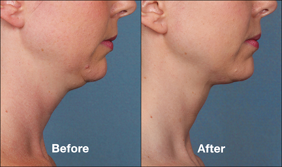 Kybella is Now Available!