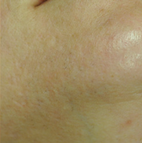 xeo hair removal a