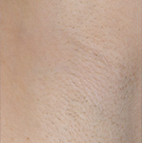 xeo hair removal a3