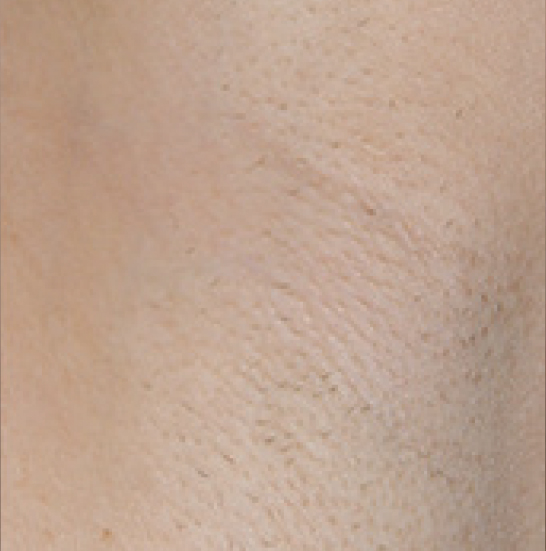 xeo hair removal a3