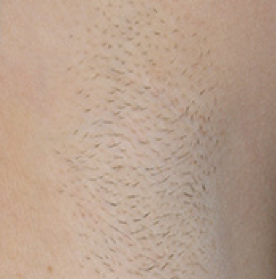 xeo hair removal b3