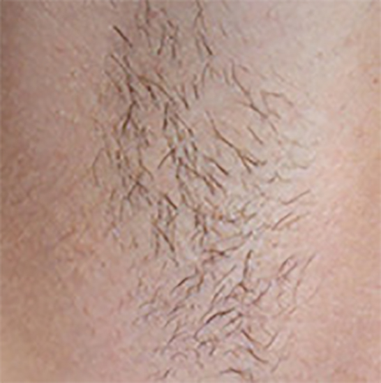 xeo hair removal b4