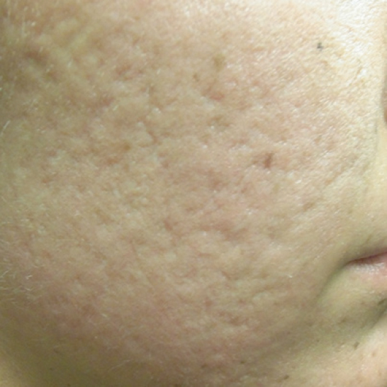 xeo skin resurface b