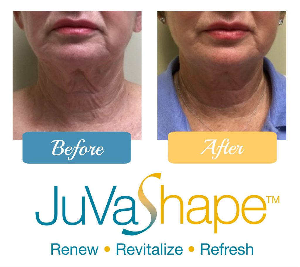 Wondering Why You Should Choose JuVaShape over Coolsculpting?<