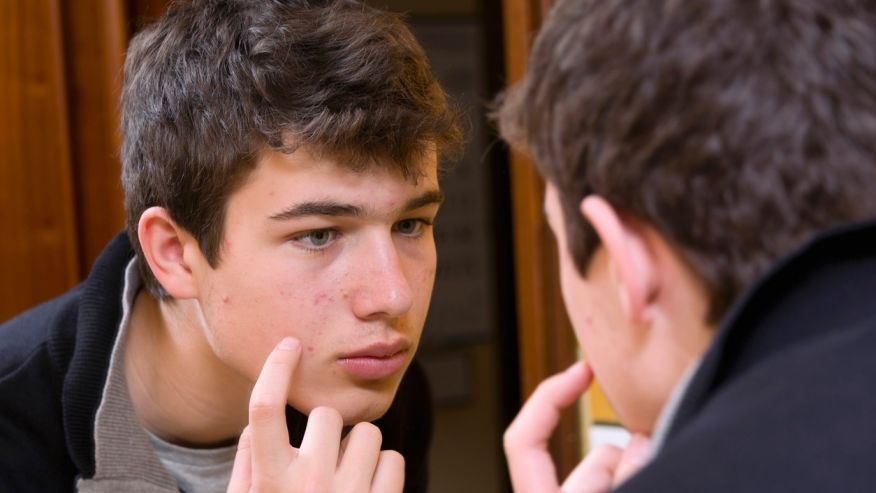 The Effects of Your Teenager’s Acne Is Not Just Superficial
