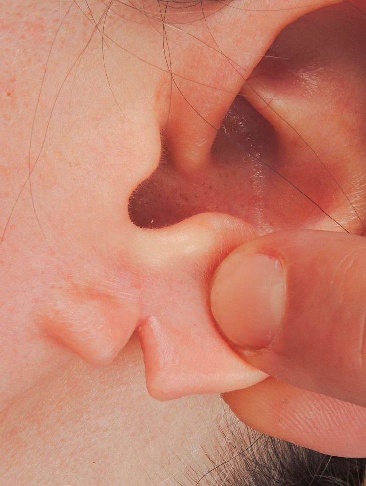 Earlobe Repair at The Woodruff Institute<