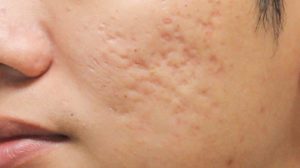 Acne-Scarring