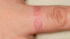 Contact-dermatitis