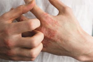 Hand-eczema-1