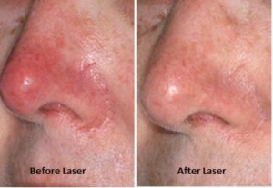 Rosacea-Before-After