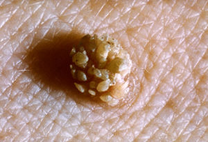 wart-magnified